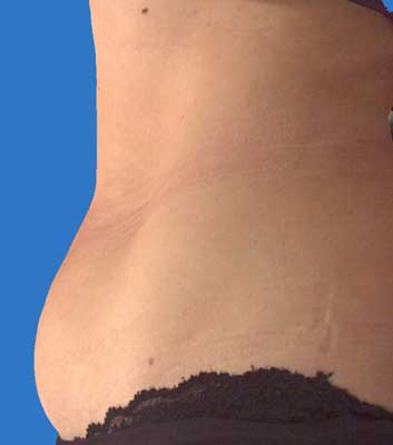 Abdomen Side Before VASER Lipo